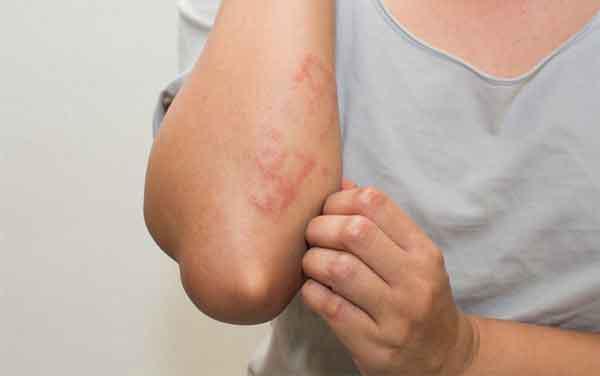 Cây ngải dại chữa viêm da cơ địa hiệu quả không? Hướng dẫn cách dùng hiệu quả